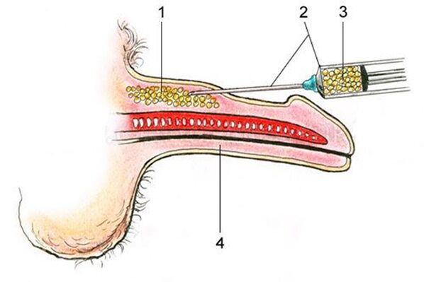 Lipofilling - het inbrengen van vetweefsel in de schacht van de penis