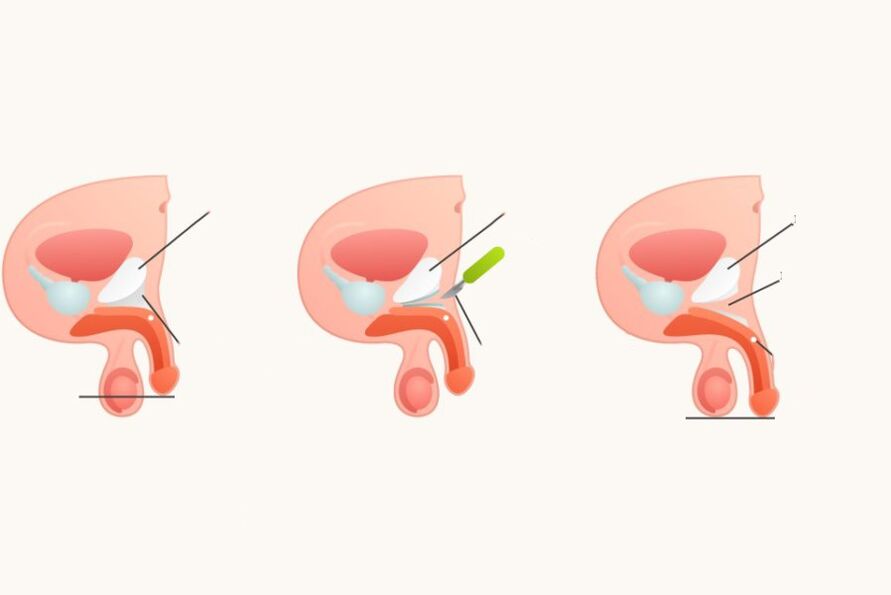 Ligamentotomie om de penis te verhogen