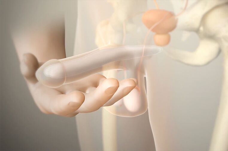 gelimplantaten om een ​​lid te vergroten