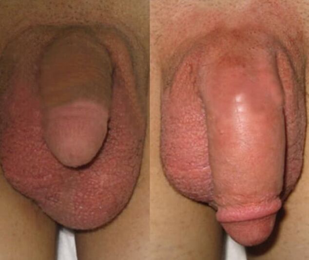 Het resultaat van het installeren van een collageenmatrix in de penis