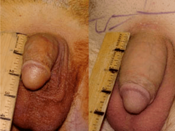 Voor en na lipofilling en gelimplantatie