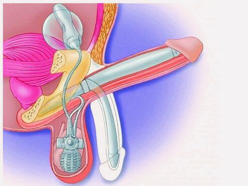 Vergroting van de penis door middel van een penisprothese
