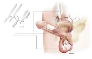 inbrengen van implantaten in de penis