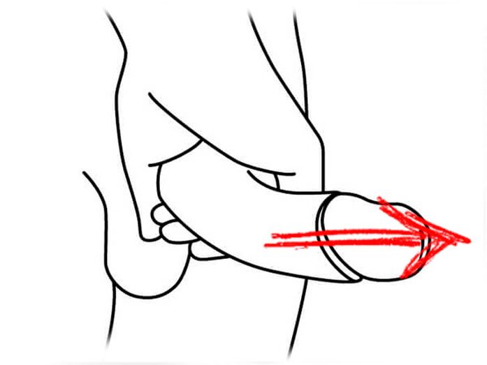 het uitrekken van de penis voor vergroting
